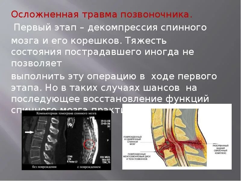 Повреждение позвоночника и спинного мозга. Осложненная травма позвоночника. Травматические повреждения спинного мозга. Осложнения перелома позвоночника