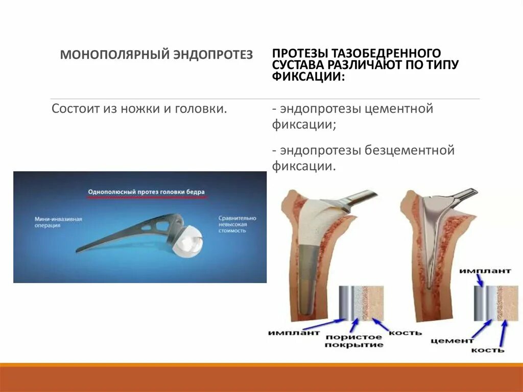 Эндопротезирование тазобедренного сустава. Монополярный эндопротез тазобедренного сустава. Однополюсный эндопротез тазобедренного. Однополюсной эндопротез коленного сустава.