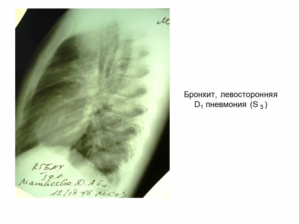 Двусторонняя бронхопневмония. Левосторонняя s3 пневмония это.