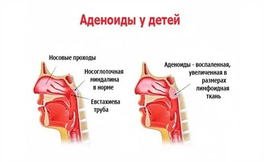 Как быстро снять отек аденоидов Аденоиды как это понимать Юрий Виноградов Дзен