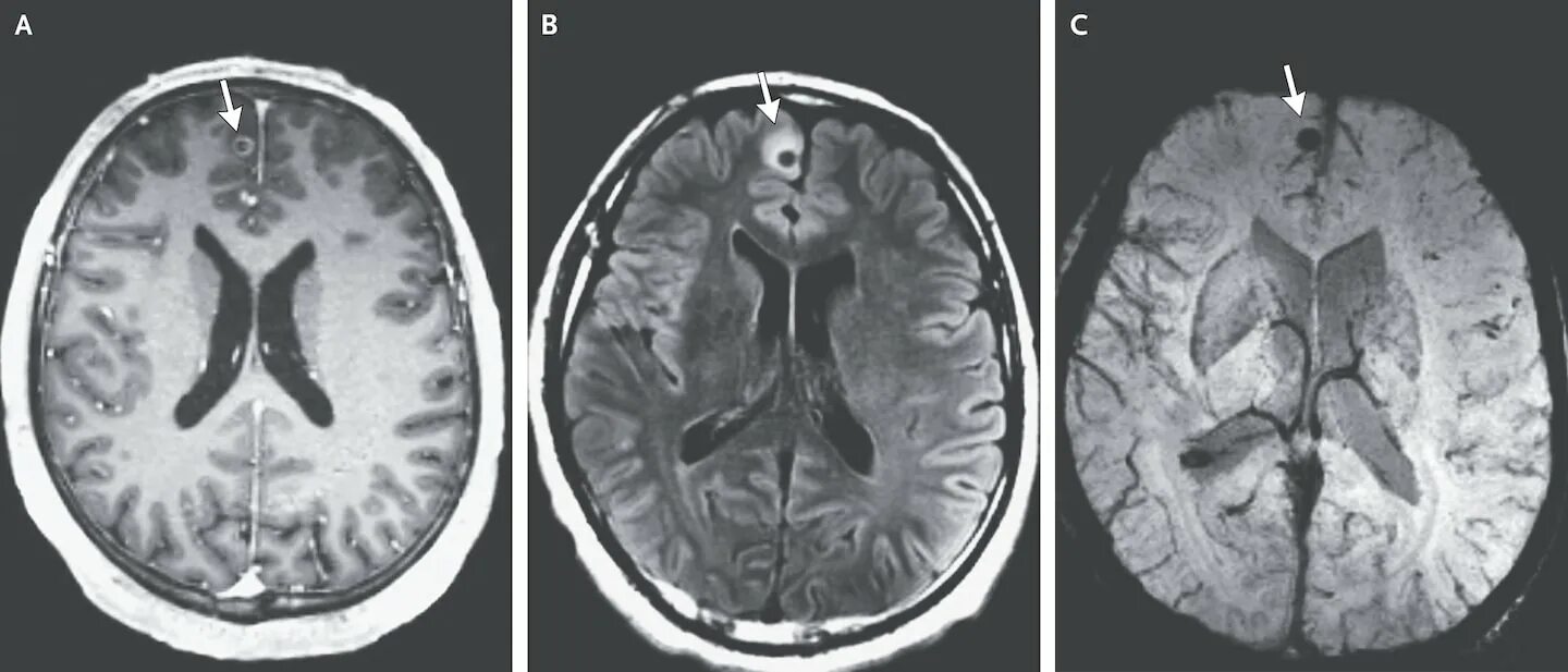 Brain 38. Нейроцистицеркоз мозга. Нейроцистицеркоз снимок мозга. Нейроцистицеркозе и эхинококкозе. Нейроцистицеркоз фото.