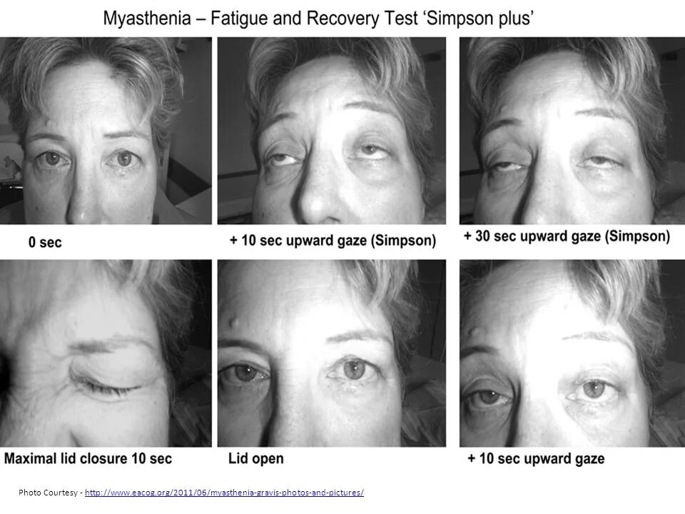 формы миастении. миастения (болезнь эрба – гольдфлама. миастения глазная форма неврология. глазная миастения. глазная миастения.