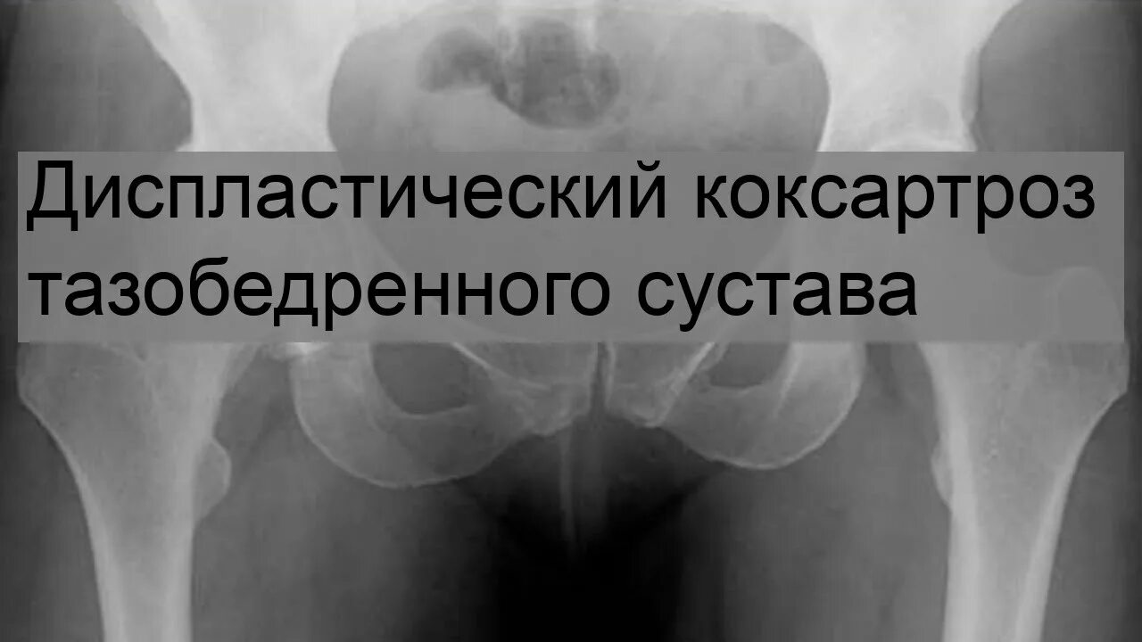 Коксартроз тазобедренного сустава 3 степени рентген. Диспластический коксартроз тазобедренного сустава у детей. Дисплазия коксартроз тазобедренного сустава. Диспластический коксартроз рентген.