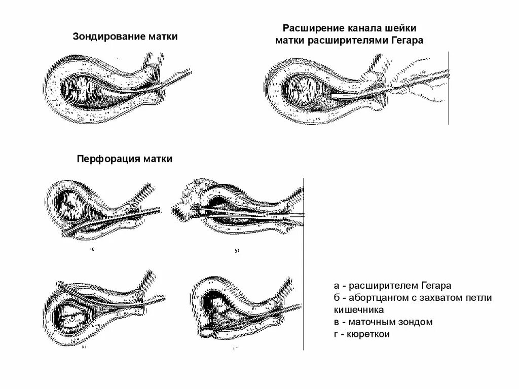 Как происходит выскабливание. Расширитель шейки матки Гегара. Инструментарий для зондирования полости матки. Зондирование полости матки инструменты. Зондирование полости матки. Показания. Техника проведения..