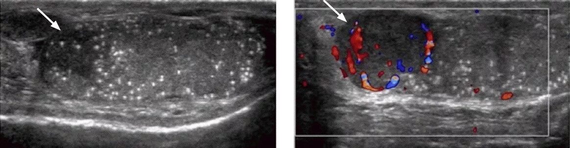 Скротальная Эхо допплерография варикоцеле. Микрокальцинаты в мошонке УЗИ.