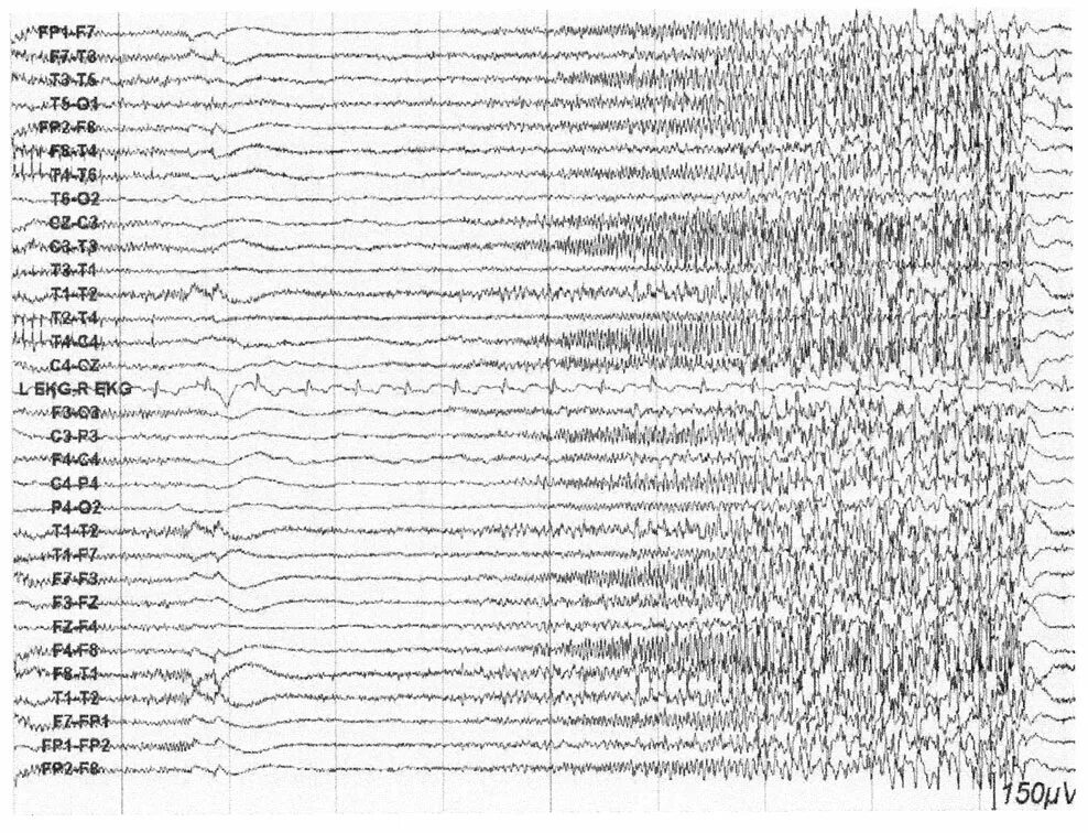 Эпи ээг. Эпилептиформная активность на ЭЭГ. ЭЭГ головного мозга эпилепсии. Эпилептиформные феномены на ЭЭГ что это. Фокальные изменения на ЭЭГ.