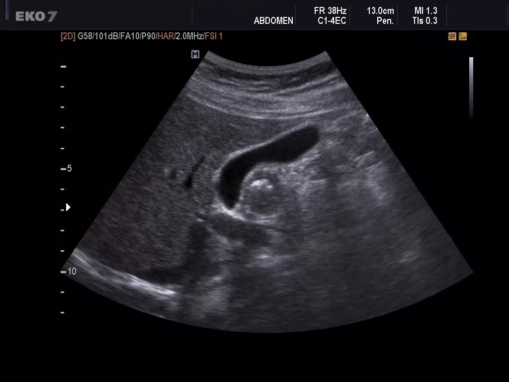 Нормальный желчный пузырь на узи. Узи желчного пузыря при жкб. Как выглядит желчный пузырь на узи. Узи желчного пузыря нормы содержимое. Ультрасонография желчного пузыря.