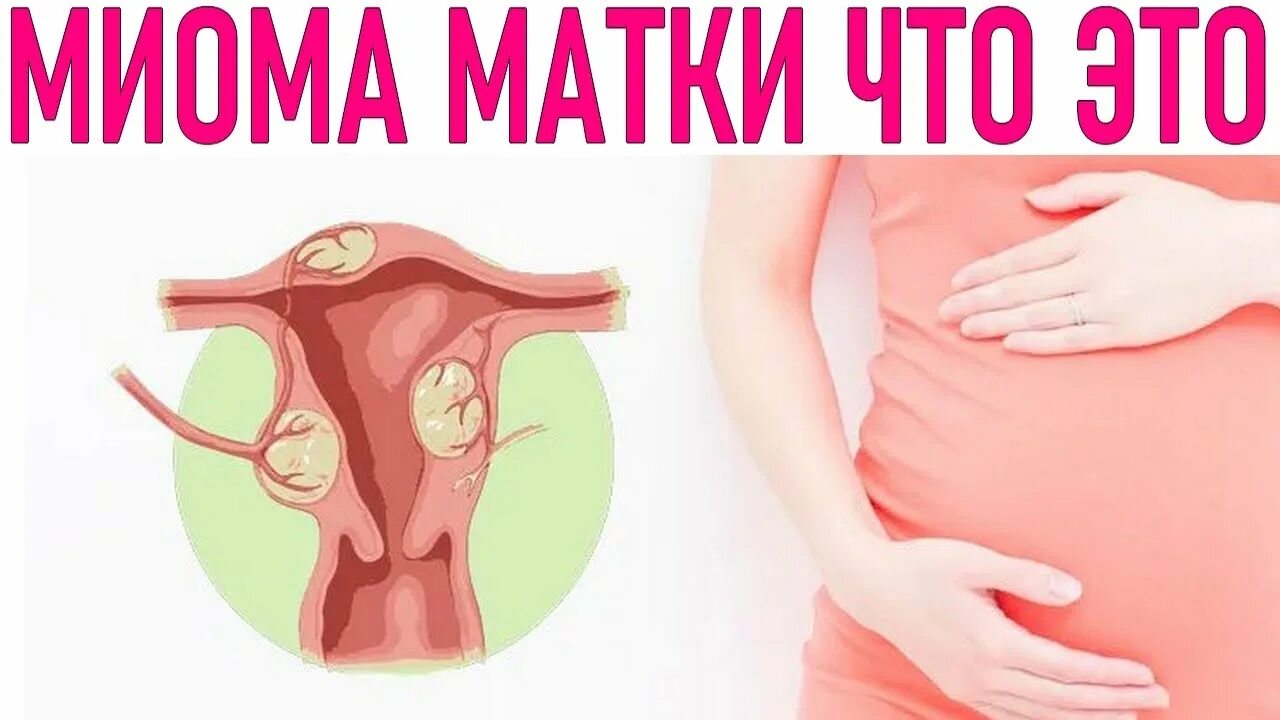 Эко при миоме матки. Миома матки при беременности. миома матки у беременной. фибромиома матки и беременность.