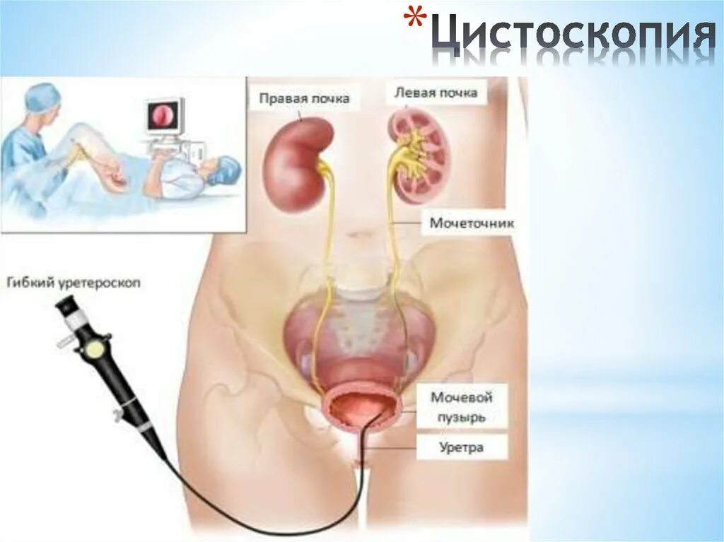 Удалили мочевой пузырь мужчине. Камни в почках через уретру. Камень из мочевого пузыря у мужчин. Камни в почке операция через уретру.