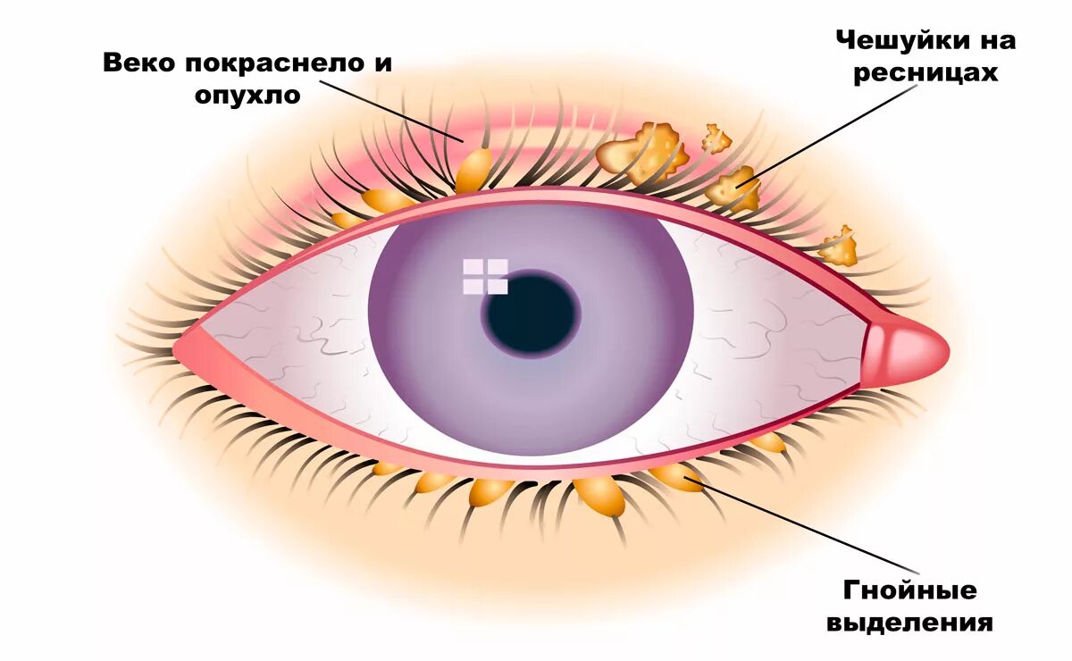 Глазной конъюнктивит лечение. Птеригиум начальная стадия. Пингвекула пингвекула птеригиум.