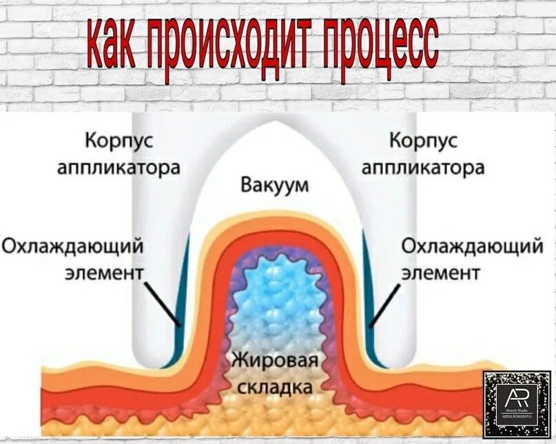 Криолиполиз как работает. Криолиполиз схема. зоны для криолиполиза схема. криолиполиз процесс. механизм действия криолиполиза.