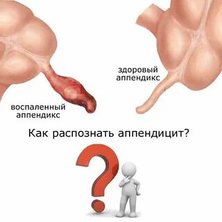 Эротикалық тыртық аппендицит фотосы