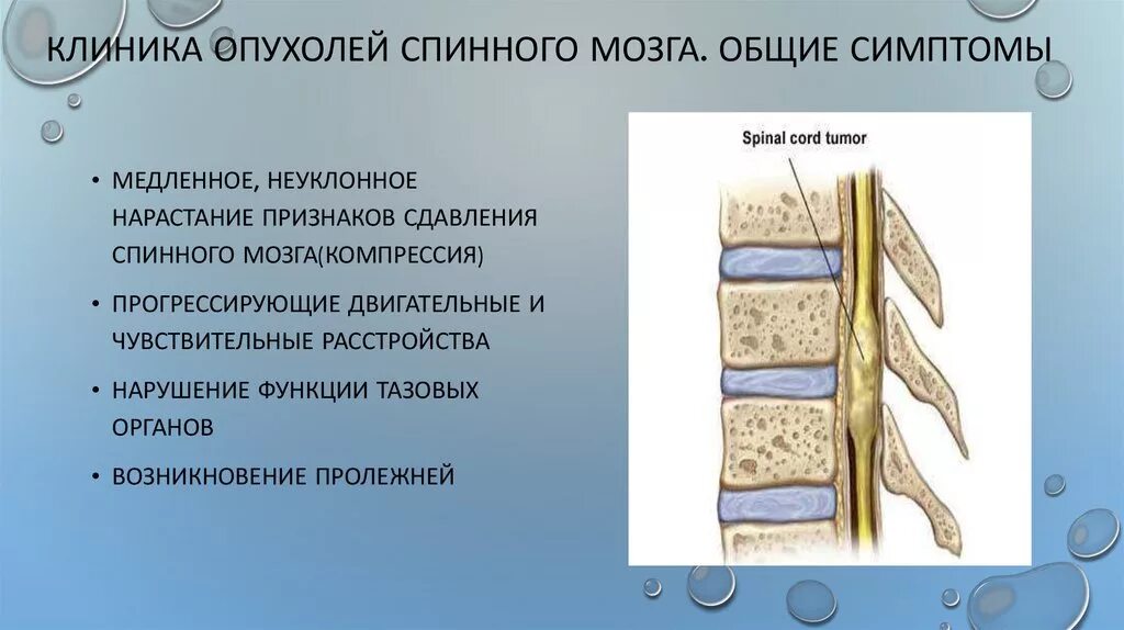 Диагностические критерии опухоли спинного мозга. Экстрамедуллярная опухоль спинного мозга клиника. Опухоль спинного мозга симптомы. Клинические проявления опухолей спинного мозга.