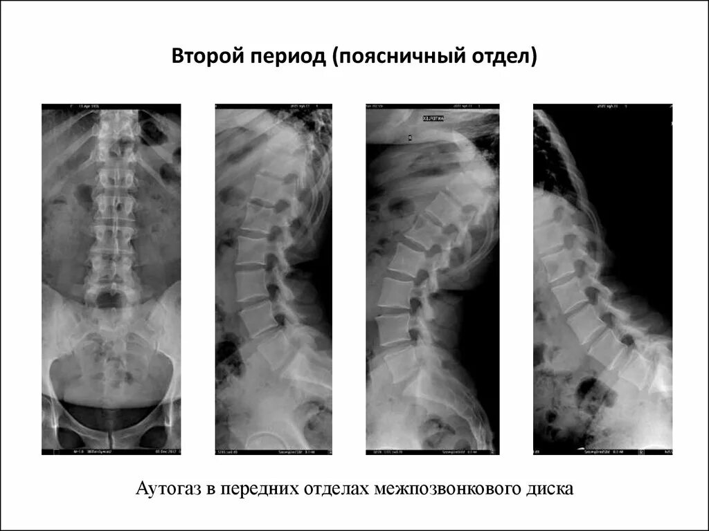 Остеохондроз поясничного отдела позвоночника периоды. Остеохондроз позвоночника периоды рентген. Остеохондроз поясничного отдела рентгенологические стадии. Остеохондроз поясничного отдела позвоночника рентген стадии. Остеохондроз поясничного отдела периоды рентген.