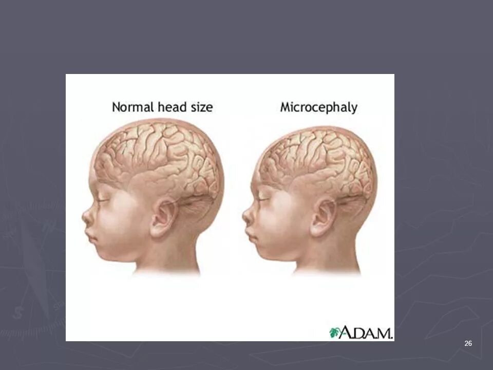 Микроцефалия причины. Микроцефалия анатомия. Микроцефалия форма черепа. Микроцефалия фенилкетонурия. Череп микроцефальной формы.