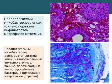 Микобактериоз легких