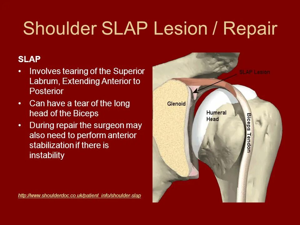 Slap повреждение плечевого сустава. Слэп повреждение плечевого сустава. Слап синдром плечевого сустава.