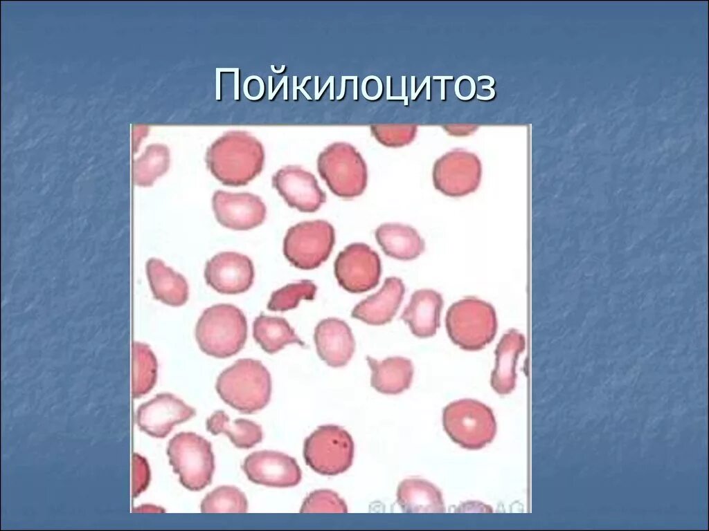 Пойкилоцитоз эритроцитов это. Эхиноциты эритроциты. пойкилоцитоз это изменение формы эритроцитов. пойкило и анизоцитоз. патологические формы эритроцитов пойкилоцитоз.