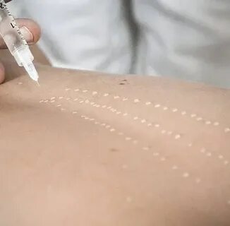 Мезотерапия спины