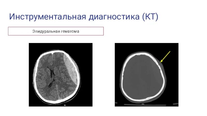 Объем гематомы на кт