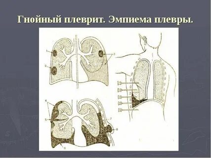 Гнойный перенести
