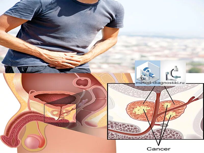 Предстательная железа у мужчин. Где расположена простата. Где находится предстательная железа у мужчин. Предстательная железа у мужчин. Расположение мужской простаты.