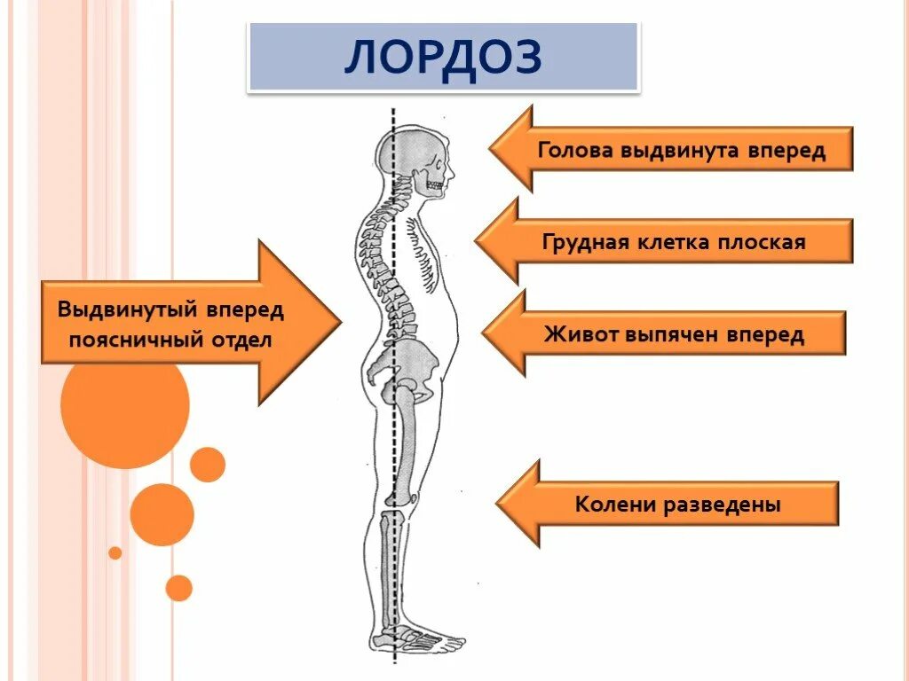 Лордоз сохранен что это значит. Лордос. лордоз. лордоз позвоночника. физиологический поясничный лордоз.
