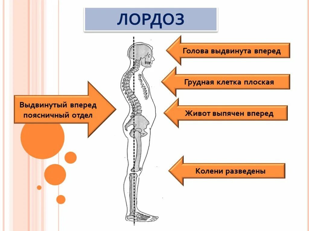 Поясничный лордоз мышцы. Физиологический лордоз поясничного отдела. Лордос. Лодоз. Изгиб позвоночника 6