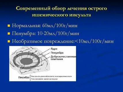 Зоны инсульта