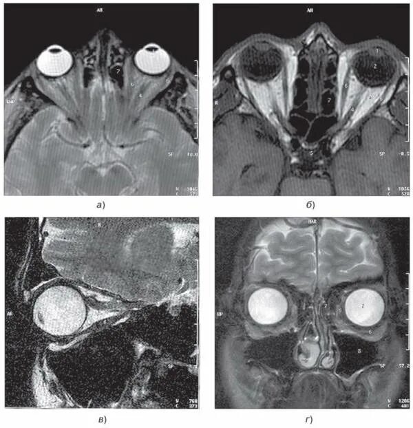 Глазных орбит и зрительных нервов. Кт орбит экзофтальм. Эндокринная офтальмопатия кт.