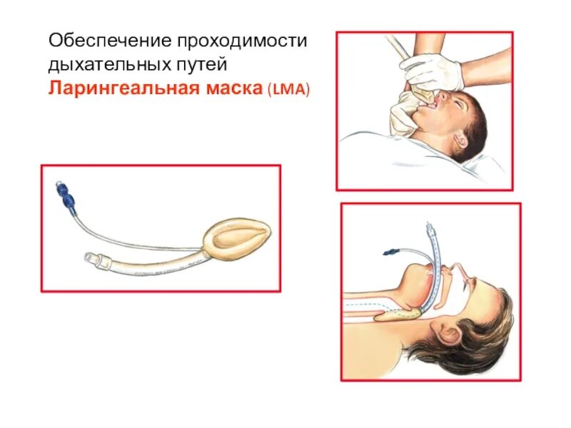 Первая маска первой помощи. Способы обеспечения проходимости дыхательных путей. Обеспечение проходимости дых путей. Обеспечение проходимости ВДП. Обеспечение проходимости дыхательных путей алгоритм.