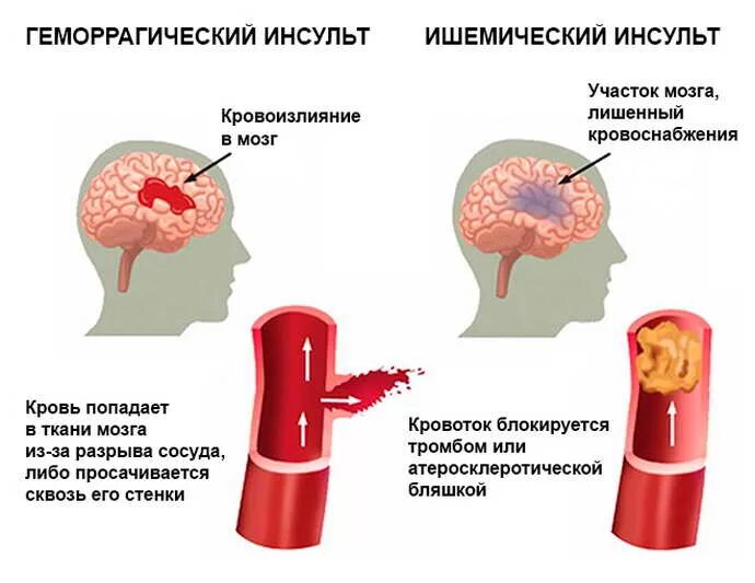 Что случается после инсульта. ОНМК геморрагический инсульт клиника. Геморрагический инсульт разрыв сосуда. Кровоизлияние в ствол головного мозга ишемический инсульт. Тромботический ишемический инсульт.