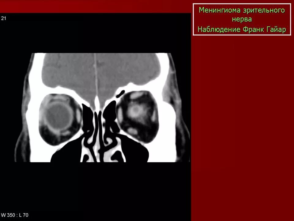 Менингиома зрительного нерва кт. Менингиома зрительного нерва мрт. Менингиома экзофтальм. Менингиома орбиты глаза.