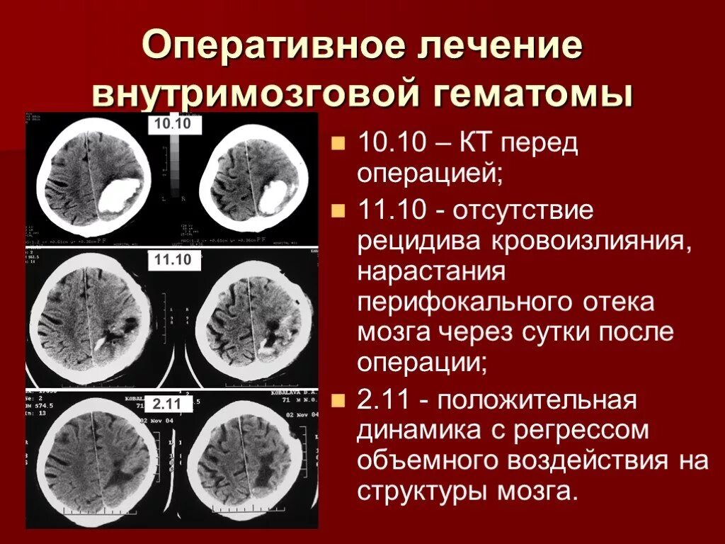 Травматическая внутримозговая гематома кт. Хроническая внутримозговая гематома на кт. Внутримозговая гематома классификация кт. Кт признаки внутримозговой гематомы. Гематома мозга операция