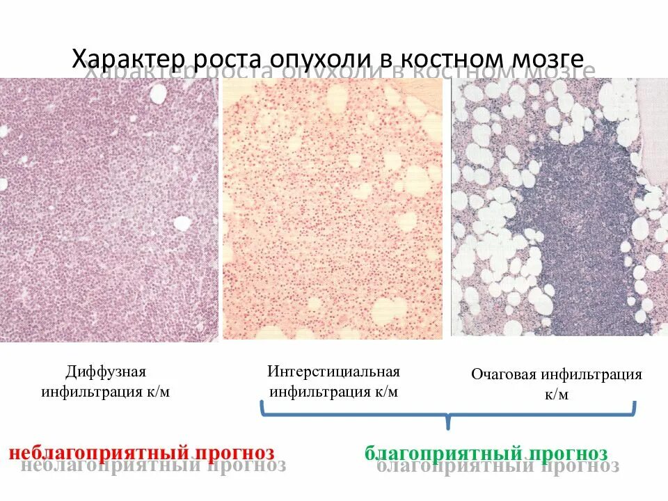 Диффузная лимфоцитарная инфильтрация. Лейкозная инфильтрация костного мозга. Опухолевая инфильтрация костного мозга. Очаговая инфильтрация костного мозга.