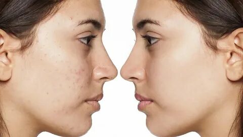 Acne removing