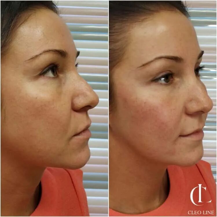 коррекция носощечной борозды филлерами. носощечные борозды. коррекция носощечной борозды. носощечные борозды. носощечная борозда.