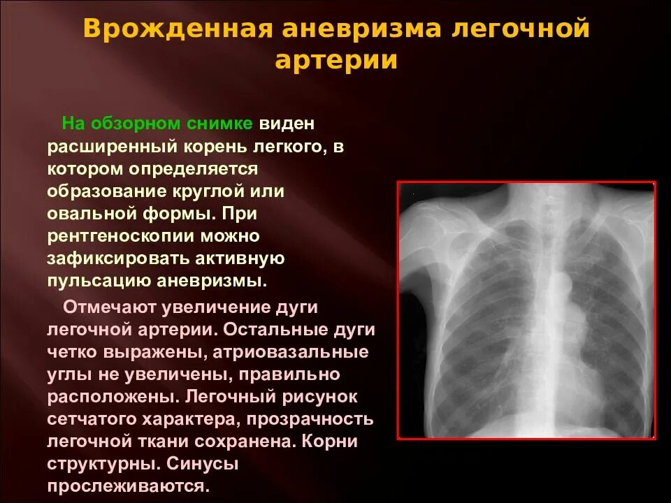 Аневризма легочной артерии. Аневризмы легочных сосудов. Расслаивающая аневризма легочной артерии. Аневризма ствола легочной артерии. Легочные корни расширены