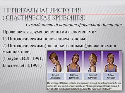 Кривошея у взрослых отзывы