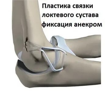 Разрыв локтевого сустава