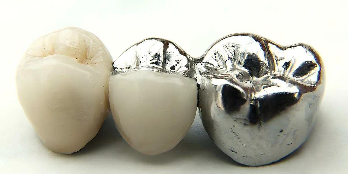 Сколько стоит металлические зубы. Коронка цельнолитая КХС. Коронка цельнолитая (сплав remanium). Металлокерамическая коронка (CR-co). Металлопластмассовые цельнолитые коронки.