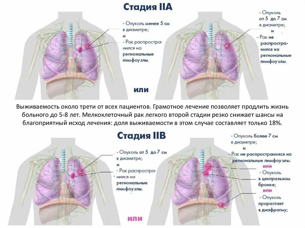 Лечение опухолей легкого. Стадии онкологии легкого. Степени онкологии легких. Онкология легких стадии. Онкология легких 4 стадия.