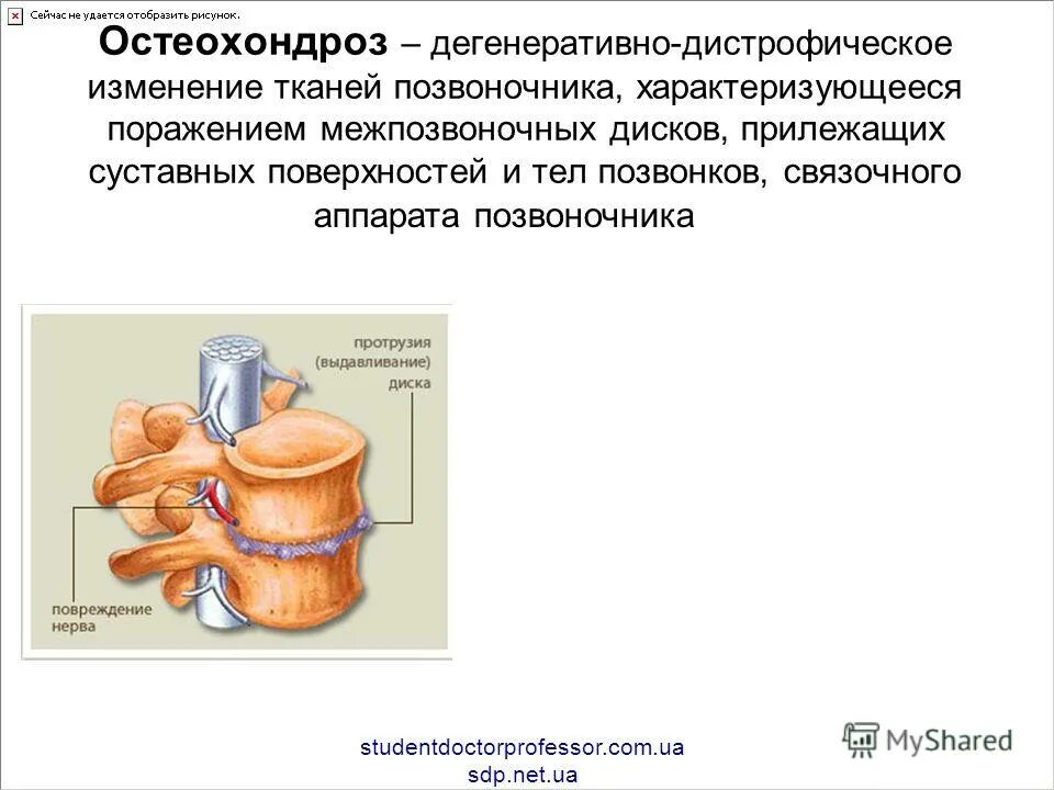 растяжение связочного аппарата позвоночника. дисторзия шейного отдела позвоночника. задняя продольная связка позвоночного столба. растяжение связочного аппарата позвоночника. растяжение связочного аппарата позвоночника.