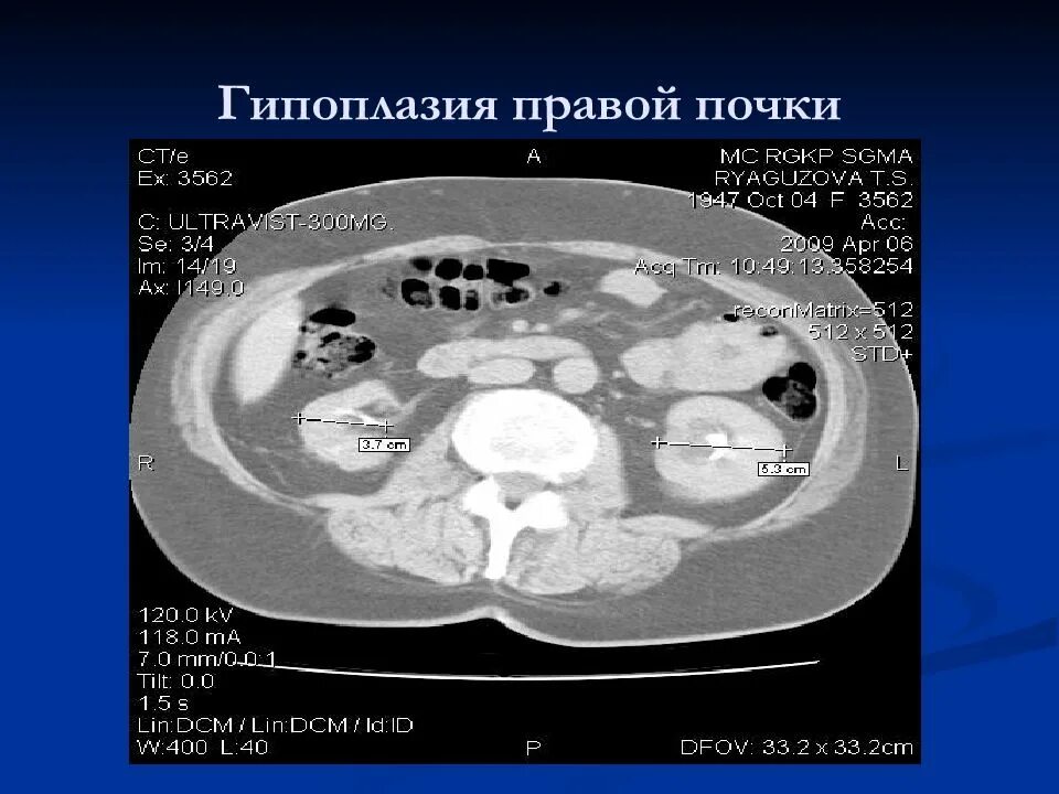 Гипоплазия почки кт признаки. Врожденная гипоплазия почки. Гипоплазия почек у детей клинические рекомендации. Правая почка меньше левой