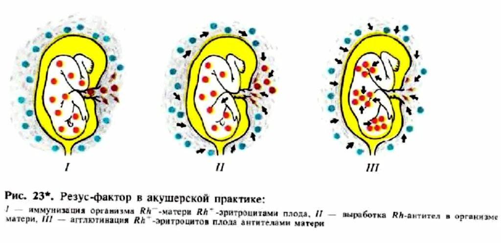 Резус фактор. Наследование резус фактора. Значение резус фактора в акушерской практике. Трансплацентарная резус-иммунизация. Рожать с отрицательным резусом