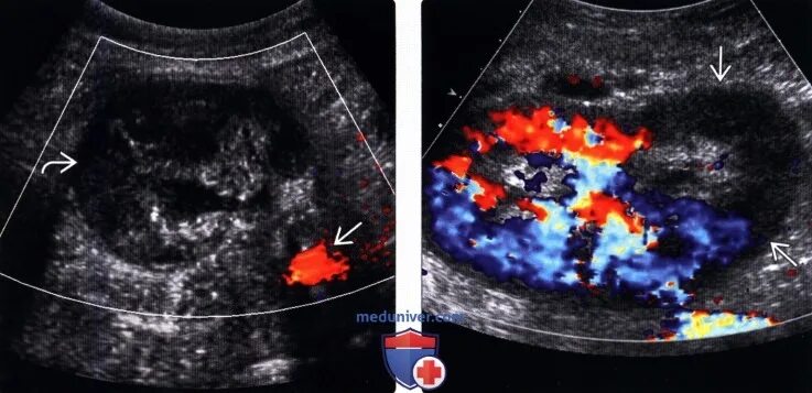 Допплерография сосудов почек. Тромбоз почечной артерии на УЗИ. Тромбоз почечной вены УЗИ. Тромбоз почечных вен на УЗИ. Тромбоз почечной артерии