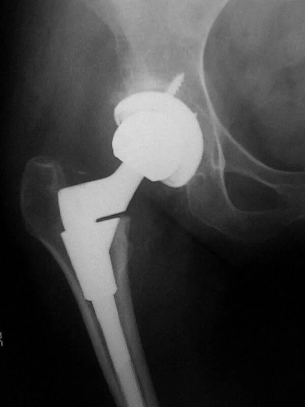 Осложнения после эндопротезирования тазобедренного. Эндопротезирование тазобедренного сустава DEPUY. Тазобедренный эндопротез Райт. Эндопротез тазобедренного сустава 32. Перипротезный перелом эндопротеза тазобедренного сустава.