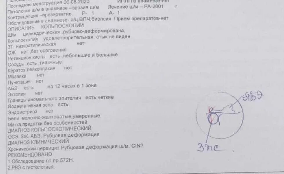 Можно ли достать до шейки матки. Кольпоскопическое заключение шейки матки. кольпоскопия описание результатов.