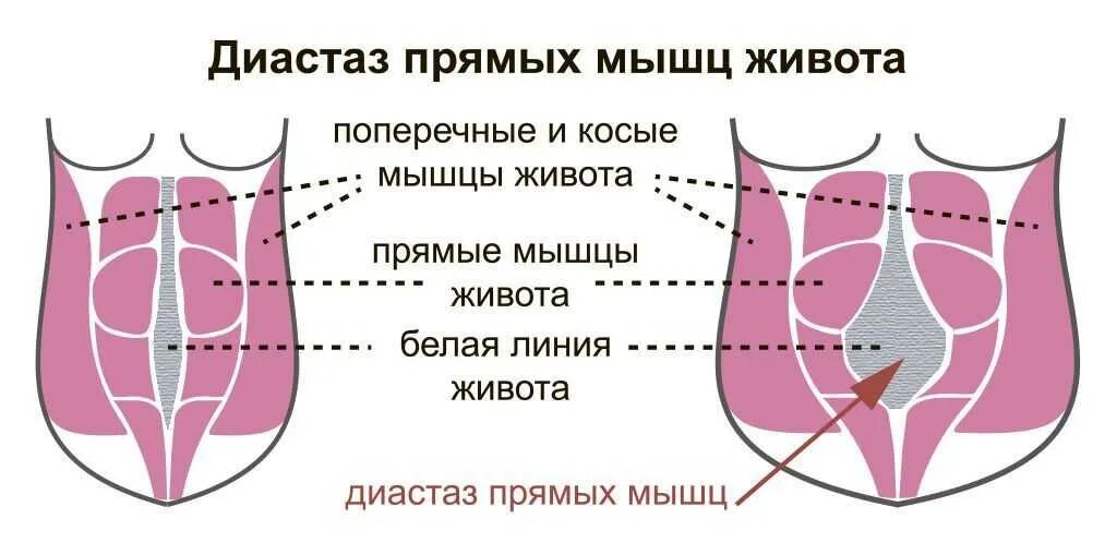 Диастаз код по мкб. Диастаз прямых мышц живота на узи протокол.