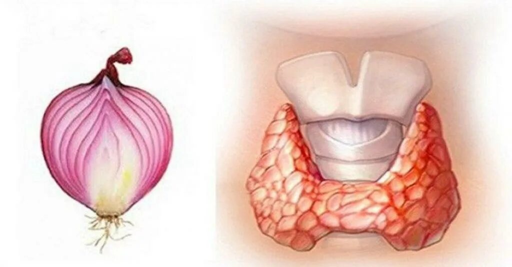 Исцеление щитовидной. Примочки на щитовидную железу. Компресс на щитовидную железу. Красный лук щитовидная железа.